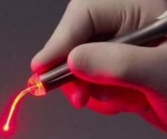 Laser Treatment for Fistula