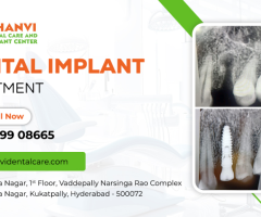 Best dental implants Vivekananda Nagar