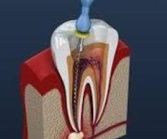 Root Canal Treatment in Deesa