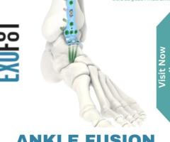 Ankle Fusion Plating System – Stabilizing Ankle Fractures