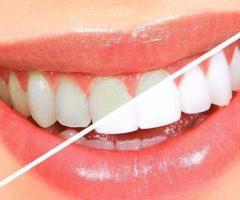 Best Teeth Whitening in Bangalore | teeth whitening cost Bangalore - 1