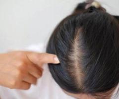 Hair Fall Treatment in Lucknow - 1