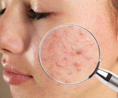 Acne Treatment in Lucknow