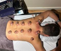 Dry Cupping Therapy