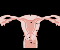 Find Out What Causes an Enlarged Uterus