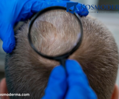 Kosmoderma: Expert Scalp Scar Removal Treatments in Delhi