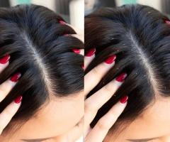 Hair Dandruff Treatment in Chennai - 1