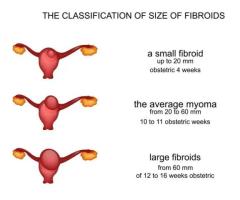 Which Size of Fibroid Is Normal? Understanding Fibroid Measurements