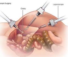 Minimally Invasive Laparoscopy for Infertility at Prem Hospital - 1