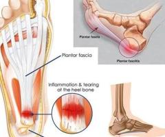 Plantar Fasciitis Surgery Center