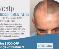 Fast and Guaranteed Results with Scalp Masters Atlanta's SMP Treatment - 1