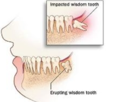 Wisdom Tooth Extraction In Bangalore | Perfect Smile - 1