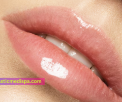 Top-Quality Lip Fillers in Riverside for Perfect Lips - 1