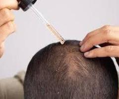 Hair Loss Treatment In Ghaziabad-Dr.Monica Bambroo Clinic - 1