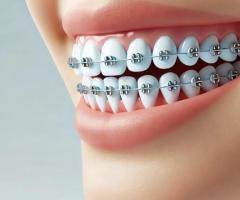 Ceramic Braces San Antonio | Amini Ortho