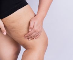 Thigh Lift in Dubai | Dr. Juan Carlos - 1