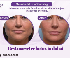 Masseter Muscle Slimming in Dubai