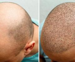 Adgro Hair Clinic : The Ultimate Solution for Hair Regrowth in Chennai