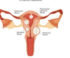 Fibroid Pain During Pregnancy: How It Affects Each Trimester