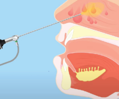 Endoscopic Sinus surgery in Dubai - 1