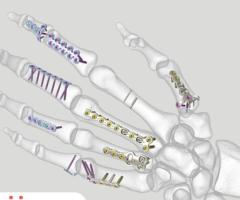 Hand Fracture Plate - Secure Fixation for Hand Injuries