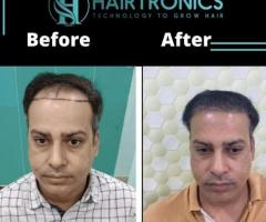 hair transplant doctor in delhi