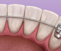 Teeth Straightening Braces in Murrieta: Pesh Orthodontics