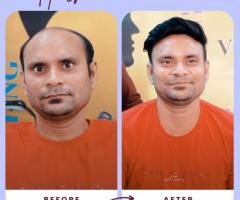 Non-Surgical Hair Replacement & Baldness Solutions in Delhi