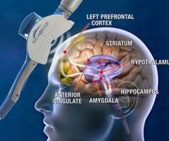 Mental Health Care with Neurostar TMS Therapy