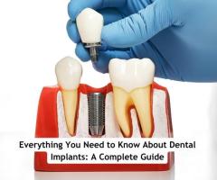 Top-Quality Dental Implants at Dermadent Clinic – Restore Your Smile Today