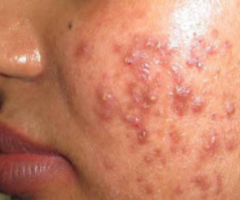 Acne Scar Treatment in Lucknow