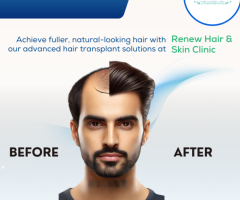 Hair Transplant in Madurai - Renew Hair and Skin Care