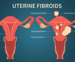 Fibroid Removal or Fibroids Surgery | USA Fibroid Centers - 1
