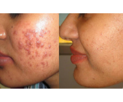 Acne Treatment in Lucknow near Indira Nagar