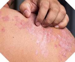 Psoriasis: Natural and Effective Homeopathic Treatment for Long-Term Relief