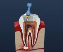 Root canal