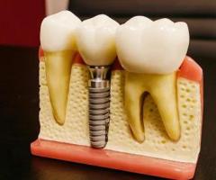 Dental Implants in Hyderabad: The Ultimate Solution for Missing Teeth