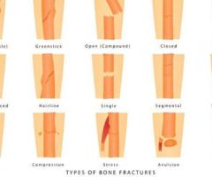 Types of Fractures