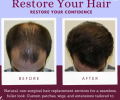 Non-Surgical Hair Replacement & Baldness Solutions in Delhi