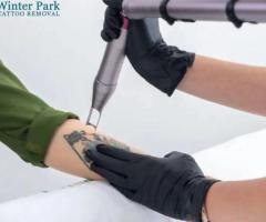 Tattoo Removal Orlando - Safe & Effective Solutions