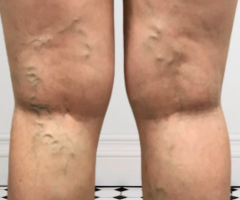 Chronic Venous Insufficiency: Find Relief with Leg Vein Rescue