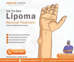 Looking for expert lipoma treatment in Delhi NCR