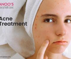 Advanced Acne removal treatment in Hyderabad