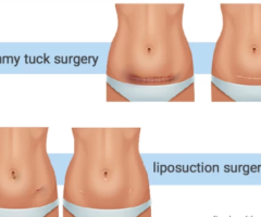 Liposuction and Tummy Tuck Surgery in Delhi: Achieve Your Dream Body with Dr. Hiranmayi Jha