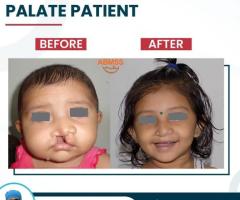 Cleft Lip and Palate Surgery in India | Best Cleft Surgeon in india