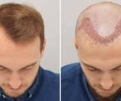 Affordable Hair Transplant Solutions in Gurgaon, Noida, and Lucknow – Restore Your Confidence