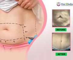 Best Tummy Tuck Surgery in India: Docplus India