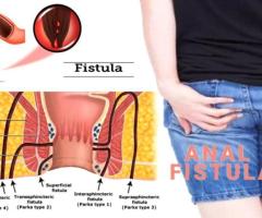 Effective Treatment for Fistula Near Mohali at Arogyam Piles Clinic