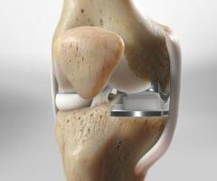 Revitalize Your Mobility: Expert Knee Replacement Services