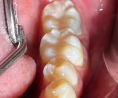 Dental implants Tijuana offers natural-looking and durable teeth replacements